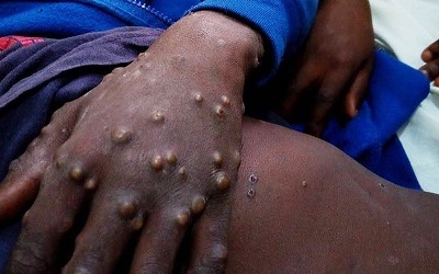 Monkeypox-1