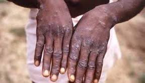 mpox
